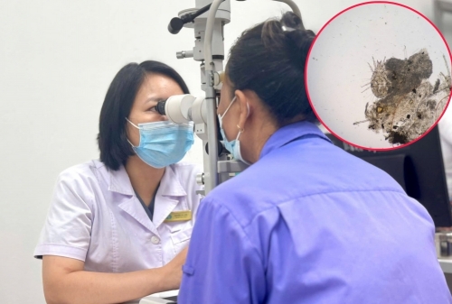 Ba năm mất ngủ vì ngứa mắt, cụ bà phát hiện rận ký sinh vùng mi