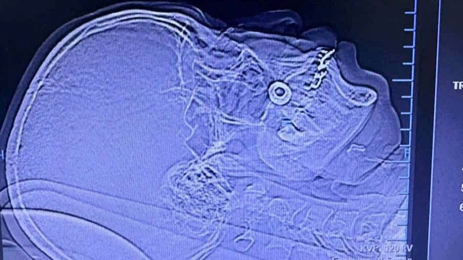 Nam thợ xây gặp tai nạn hy hữu, đầu vít găm vào má khi đang làm việc