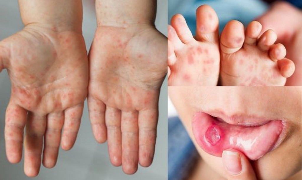 Dự báo số mắc có thể gia tăng khi các trường mầm non và tiểu học tiếp nhận trẻ đi học trở lại. Ảnh minh họa