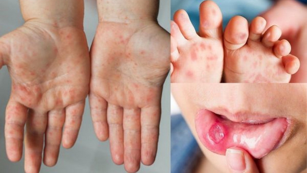 Hà Nội: nhiều ổ dịch sốt xuất huyết vẫn hoạt động, số ca mắc tay chân miệng gia tăng