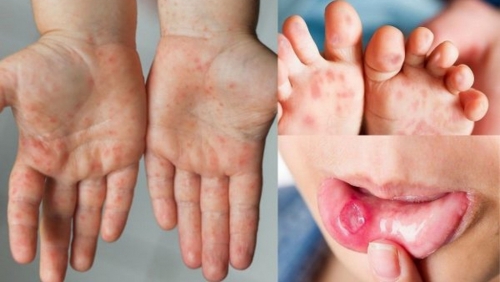 Hà Nội: nhiều ổ dịch sốt xuất huyết vẫn hoạt động, số ca mắc tay chân miệng gia tăng