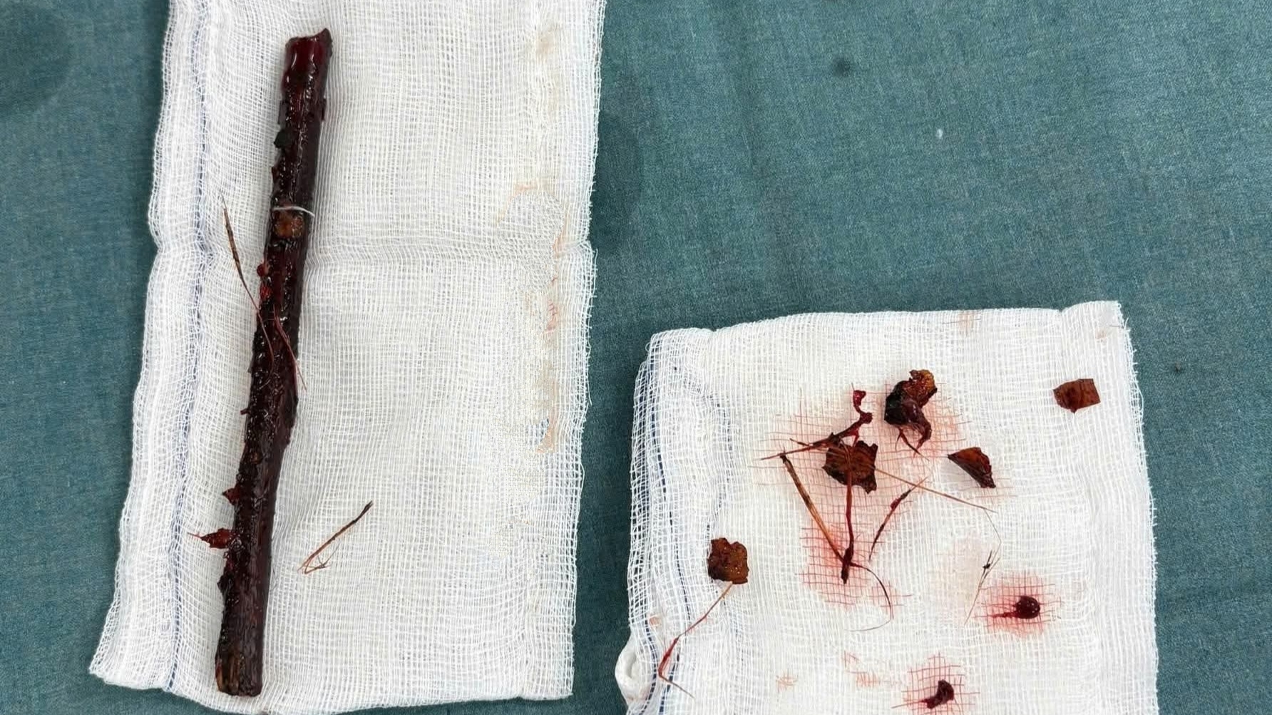 Bé gái 3 tuổi mang cành cây dài 16cm trong ổ bụng suốt hơn 4 tháng