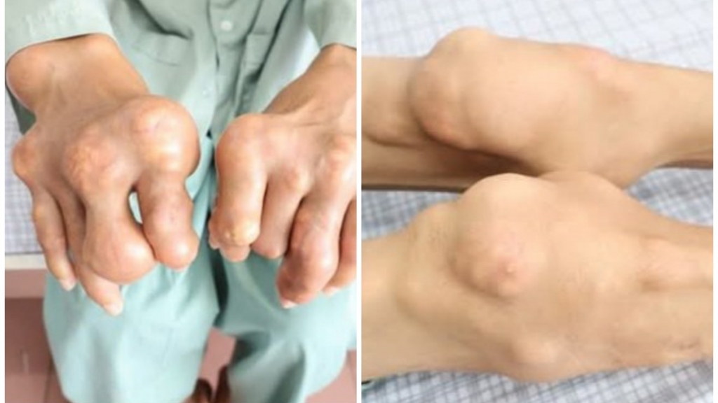Nổi hạt tophi khắp người vì tự ý điều trị bệnh gout suốt 20 năm