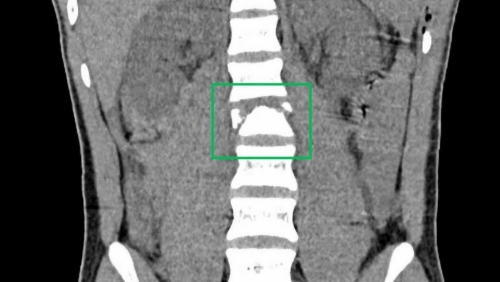 Bé trai 14 tuổi liệt hai chân sau tai nạn giao thông