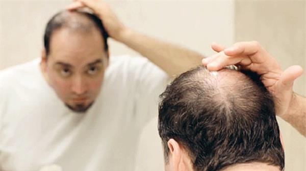 Thói quen ăn uống ít ai ngờ đến khiến nam giới hói đầu sớm