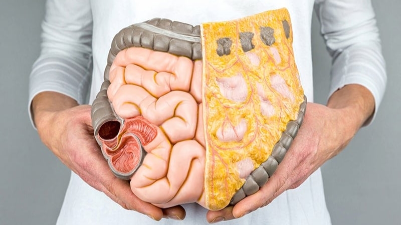 Mỡ nội tạng – “kẻ giết người thầm lặng” và cách loại bỏ hiệu quả