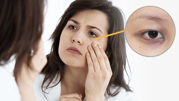 Giảm quầng thâm dưới mắt: bí quyết từ dinh dưỡng và thực phẩm giàu collagen