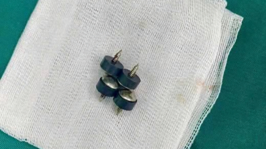 Cấp cứu thành công bé trai nuốt bốn viên nam châm đầu nhọn