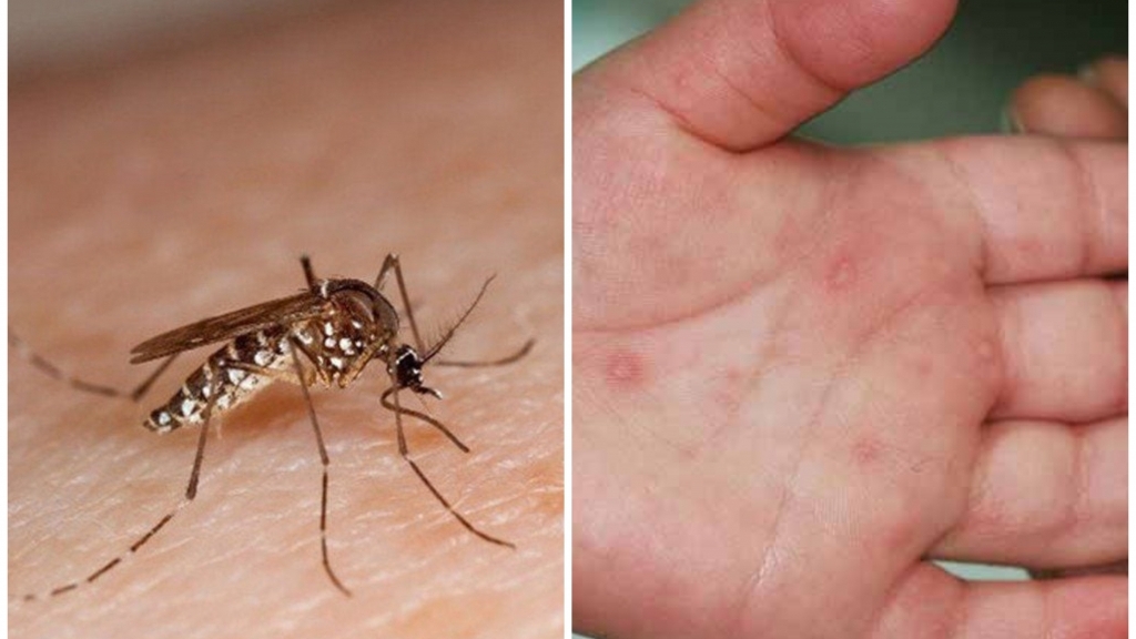 Bộ Y tế khuyến cáo tăng cường phòng bệnh sốt xuất huyết và tay chân miệng