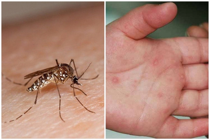 undefined Bộ Y tế khuyến cáo tăng cường phòng bệnh sốt xuất huyết và tay chân miệng