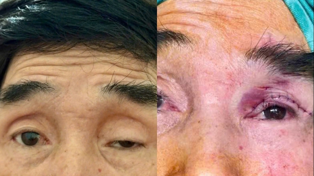 Giải phóng đôi mắt sau hơn nửa thế kỷ bị che khuất