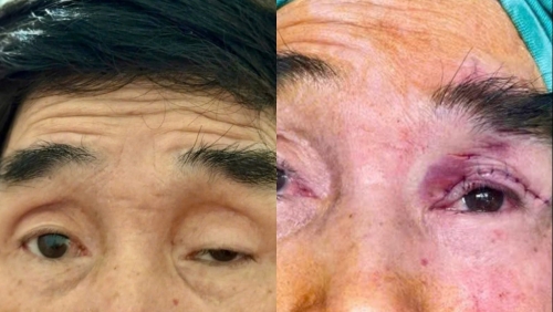 Giải phóng đôi mắt sau hơn nửa thế kỷ bị che khuất