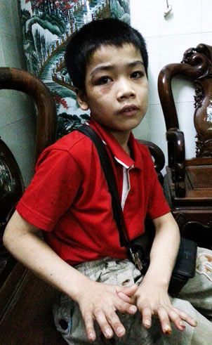 Chân dung kẻ chích thuốc lá vào tay trẻ, Tin tức trong ngày, chan dat tre an xin, bao hanh tre em, chich thuoc la dang chay vao tay tre, danh tre, chan dat an xin, ban hoa dao, ong chu, bao hanh, bao, tin tuc, tin hot, tin hay, vn