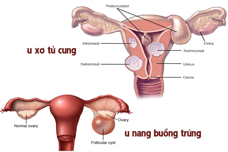 Nga Phụ Khang giúp cải thiện u xơ tử cung, u nang buồng trứng