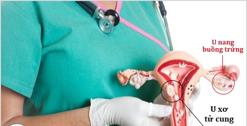 Bệnh u xơ tử cung, u nang buồng trứng và những điều bạn chưa biết benh u xo tu cung u nang buong trung va nhung dieu ban chua biet