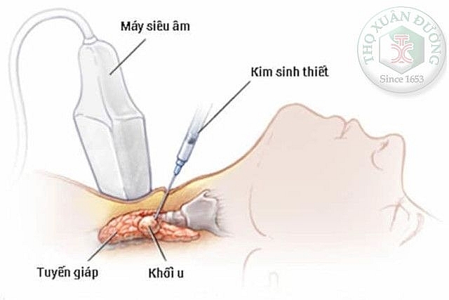 ich giap vuong ho tro dieu tri buou nhan keo tuyen giap nhu the nao