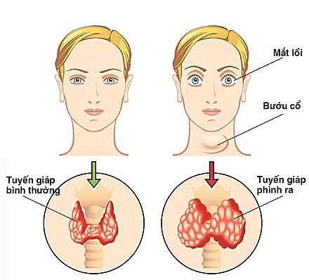 ich giap vuong ho tro dieu tri buou nhan keo tuyen giap nhu the nao