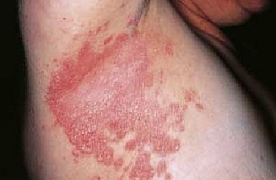 Kim Miễn Khang & Explaq - Xua tan nỗi lo vảy nến thể đảo ngược kim mien khang explaq xua tan noi lo vay nen the dao nguoc