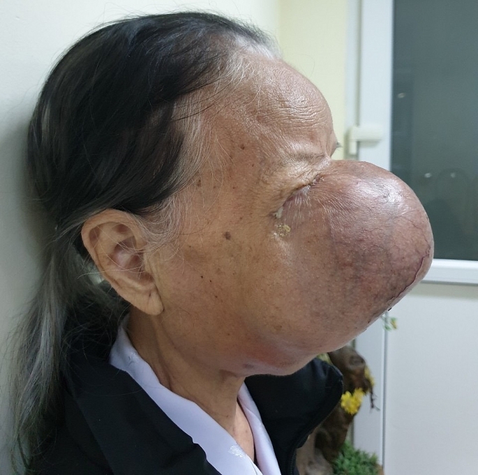 Giải cứu cụ bà khỏi khối u xơ mạch “khủng” choán nửa khuôn mặt
