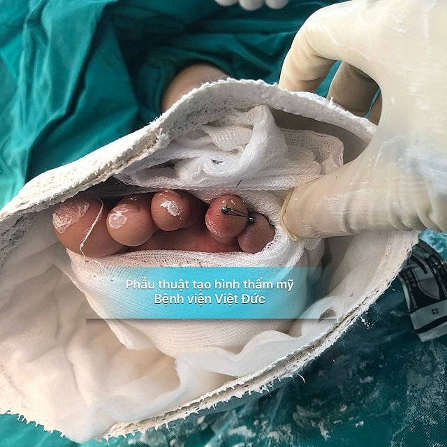 Nối thành công ngón chân bé trai bị cắt đứt bởi “lưỡi gió” xe ga be trai bi cat dut ngon chan boi luoi gio xe ga