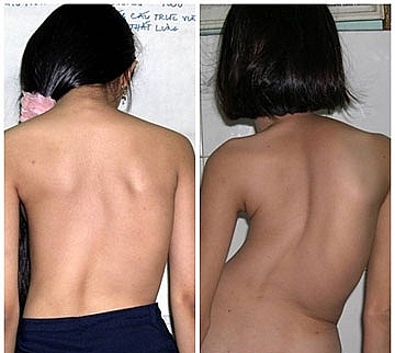 Khám miễn phí bệnh cong vẹo cột sống cho trẻ em kham mien phi benh cong veo cot song cho tre em