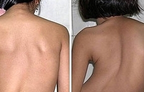 Khám miễn phí bệnh cong vẹo cột sống cho trẻ em