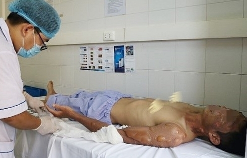 Thanh niên bị bỏng vùng mặt, cánh tay vì rò khí ga