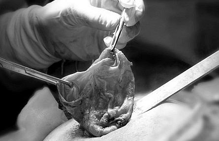 Túi nâng ngực vỡ, người phụ nữ bị các mảnh silicon công nghiệp dính chặt vào các mô tuyến ngực
