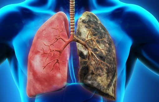 Mỗi năm có hơn 20 nghìn người Việt chết vì ung thư phổi