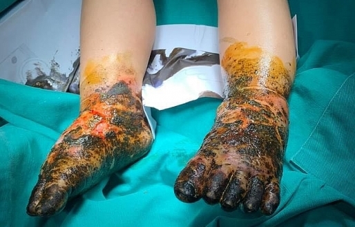 Bé trai nhiễm trùng nặng toàn bộ 2 bàn chân sau khi đắp thuốc Nam chữa bỏng