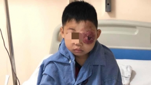 Bé trai 8 tuổi mang khối u khủng ở mắt khiến rỉ máu, mất thị lực