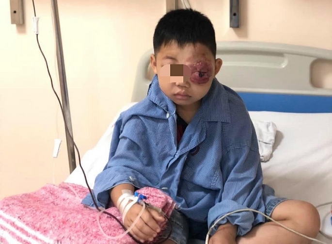 Bé trai 8 tuổi mang khối u khủng ở mắt khiến rỉ máu, mất thị lực